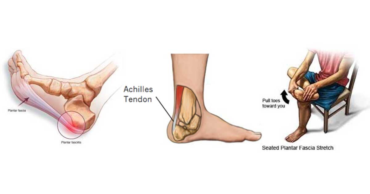 Plantar Fasciitis: heel pain causes, symptoms, treatments and cure